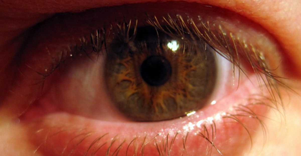 दिल्ली में आई फ्लू और डेंगू के मामलों में रिकॉर्ड वृद्धि